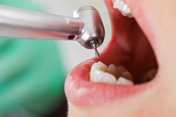 Best Dentist for Tooth Abscess  in Wildomar, CA